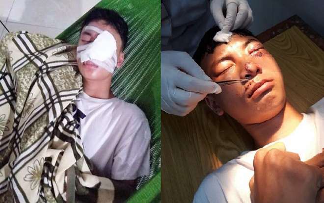 Nam sinh lớp 10 bị nát mặt vì chó lạ tấn công trên đường đi học Ảnh 2