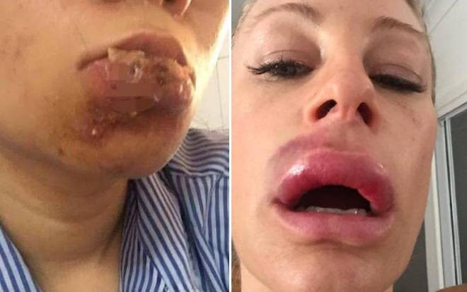 Những đôi môi sưng 'siêu to, khổng lồ' vì tiêm filler giá rẻ, coi xong sợ đến già Ảnh 2