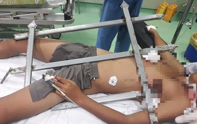 Cứu sống bé trai 13 tuổi ở Nghệ An bị thanh sắt đâm thấu ngực khi trèo cây chơi Ảnh 2