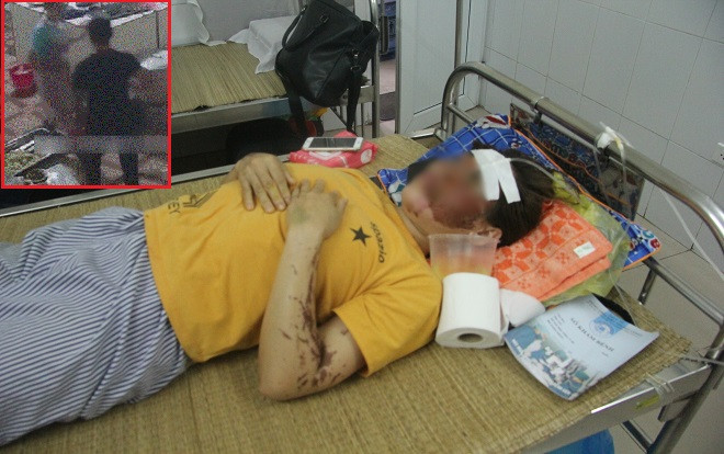 Nữ nhân viên phụ bếp bị kẻ lạ tạt axit vào mặt: 'Lúc đó tôi quá bất ngờ, chỉ biết ôm mặt chạy ra chậu nước' Ảnh 2