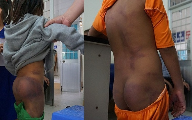 4 cháu tiểu học bị ông nội và 2 chị đánh gãy xương, bầm tím khắp cơ thể vì nghịch nước Ảnh 2