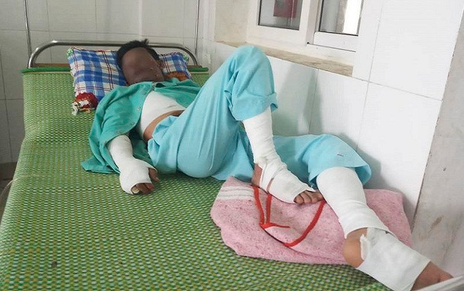 Điện thoại phát nổ trong lúc sạc pin, 9x bị bỏng nặng khi bỏ chạy vấp vào phích nước sôi Ảnh 2