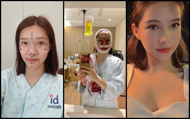 Lưu Đê Ly bất ngờ công khai quá trình 'đập đi xây lại' vì muốn xinh như Quỳnh búp bê Ảnh 2