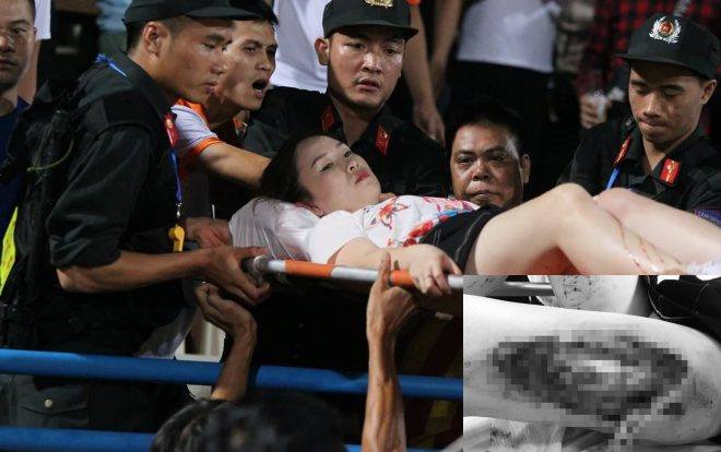 Nữ cổ động viên bị pháo bắn trúng trên sân Hàng Đẫy được xác định bị tổn thương do công phá từ sức nổ với kích thước 15-30cm Ảnh 2