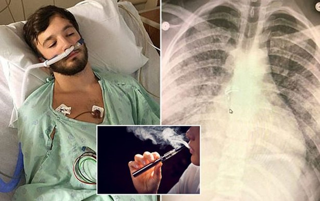 Hút thuốc lá điện tử suốt 18 tháng, lá phổi của thanh niên 'không khác gì người 70 tuổi' Ảnh 2