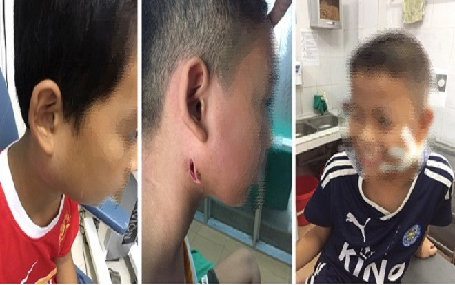 Phát hiện 3 cháu bé nhiễm 'vi khuẩn ăn thịt người' ở Nghệ An Ảnh 2