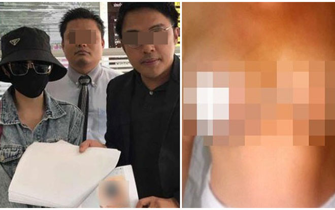 Phẫu thuật thu nhỏ vòng một được vài ngày, cô gái 'khóc thét' vì điều kinh khủng này Ảnh 2