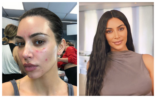 Kim Kardashian chia sẻ ảnh mặt mộc đầy vết tấy đỏ do căn bệnh vẩy nến để lại khiến ai nhìn cũng xót xa Ảnh 2