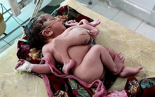 Bé gái sinh ra có 4 chân và 3 tay ở Ấn Độ Ảnh 2