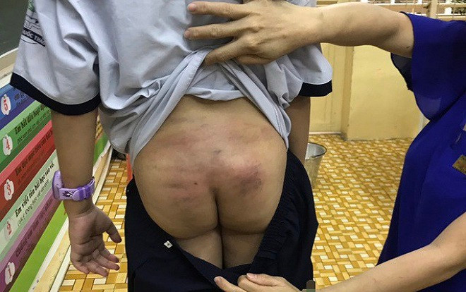 Nghi vấn bé trai 11 tuổi bị bạo hành trong thời gian dài khi ở cùng bố và mẹ kế tại Sài Gòn Ảnh 2
