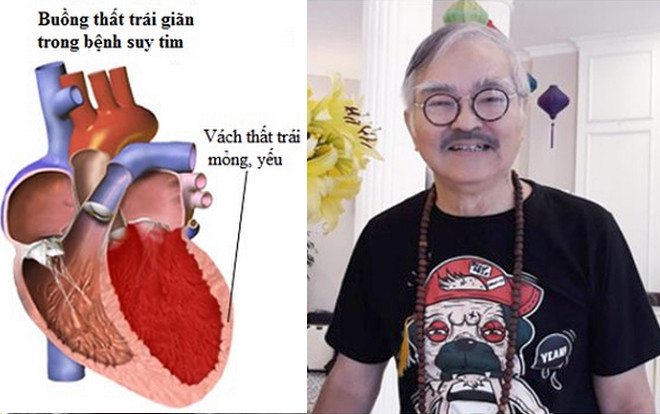 Biến chứng nhồi máu cơ tim khiến NSND Thế Anh đột ngột qua đời nguy hiểm ra sao? Ảnh 2