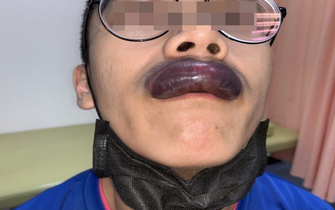 Thanh niên phát hoảng vì môi bị sưng to như xúc xích sau khi ngủ dậy Ảnh 2