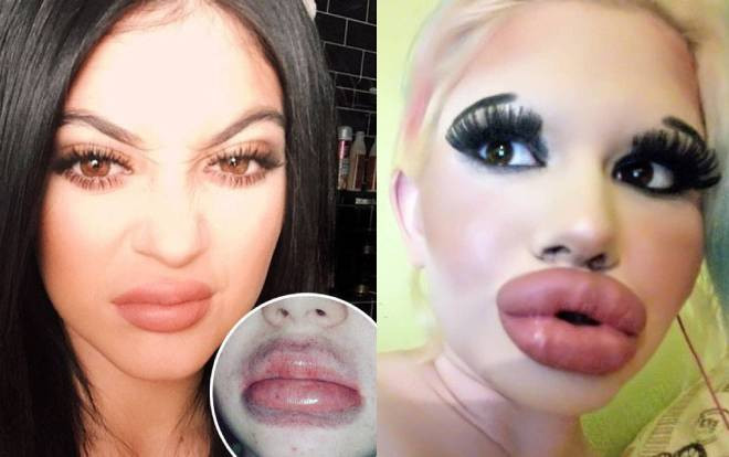 Thảm họa thẩm mỹ: Đôi môi 'siêu to khổng lồ' như sắp nổ tung vì bơm vá dao kéo Ảnh 2