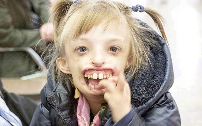 Bé gái khuyết nửa khuôn mặt lần đầu tiên có thể cười Ảnh 2