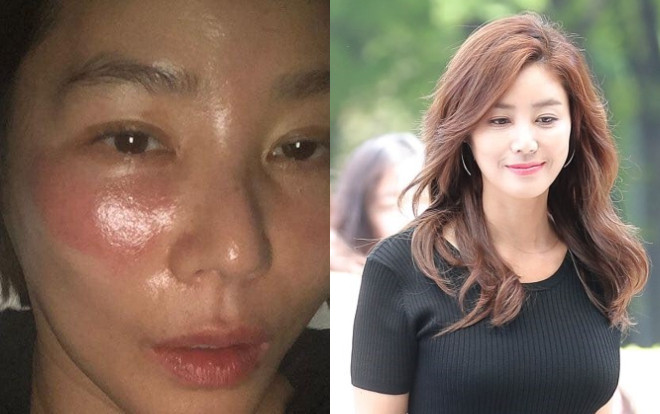Lỡ đắp mặt nạ qua đêm, Hoa hậu Hàn Quốc bị bỏng rát sưng tấy đỏ cả mặt Ảnh 2