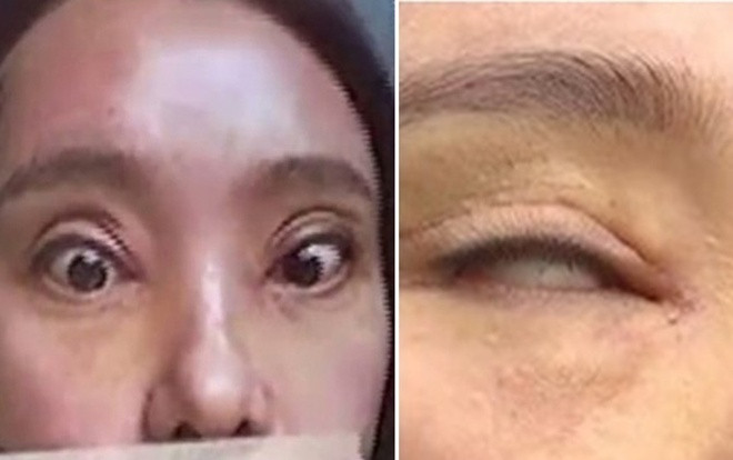 Mất tiền nâng mí mắt, cô gái nhận kết cục thảm thương Ảnh 2