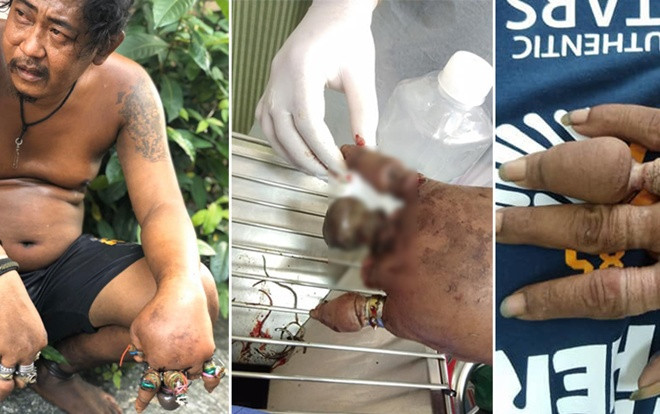 Ngón tay người đàn ông hoại tử phải cắt cụt hàng loạt vì lý do này Ảnh 2