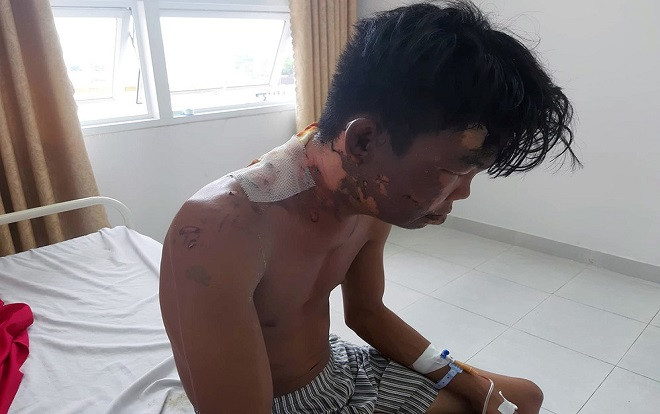 Thanh niên bị chị ruột đổ nước sôi vào đầu gây bỏng nặng Ảnh 2