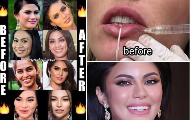 Đối thủ Hoàng Thùy - Tường San bị đào xới ảnh 'dậy thì thành công' nhờ dao kéo Ảnh 2