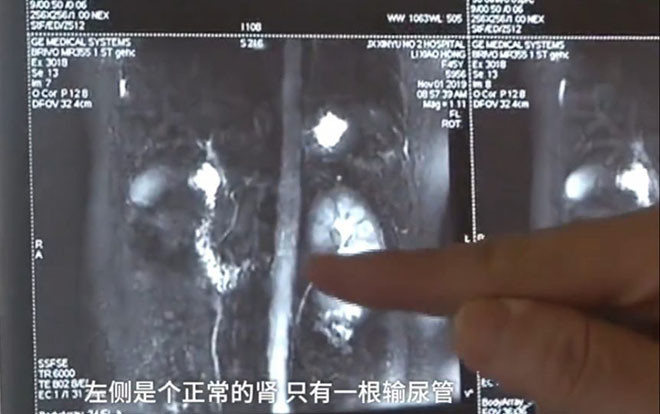 Phát hiện mình có 3 quả thận, nữ bệnh nhân quyết đoán làm điều này khiến ai cũng nể phục Ảnh 2