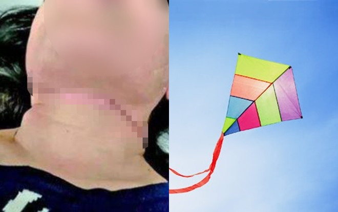 Đang đi đường, hai người phụ nữ bị dây diều rạch đứt cổ Ảnh 2