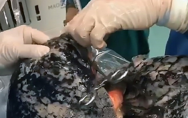 Sốc với hình ảnh lá phổi 'đen như than' của người đàn ông 52 tuổi hút thuốc lá trong suốt 30 năm Ảnh 2