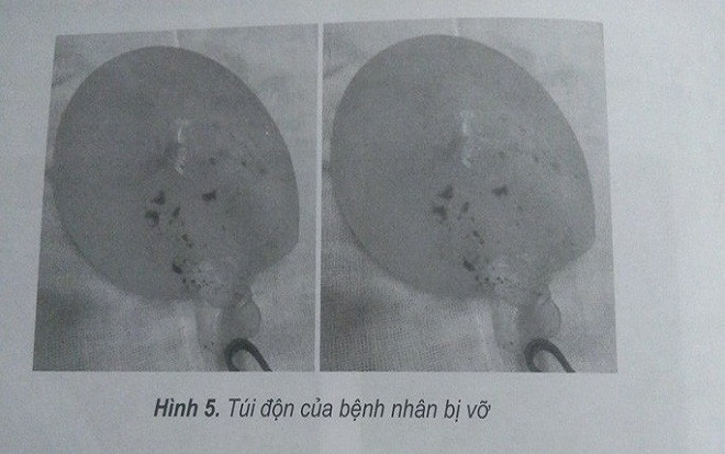Cô gái 28 tuổi ở Sài Gòn bị vỡ 2 túi độn ngực cùng lúc Ảnh 2