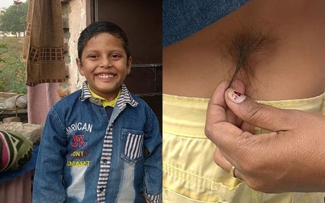 Mọc 'đuôi' sau lưng, cậu bé 6 tuổi được tôn sùng như thần khỉ Ảnh 2