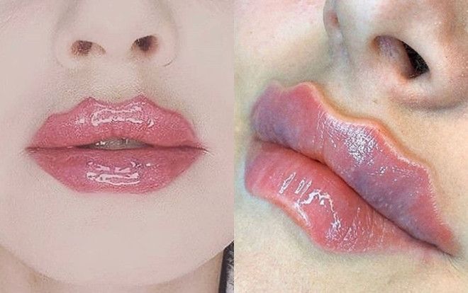 Bờ môi lượn sóng kỳ quái đang gây sốt Ảnh 2