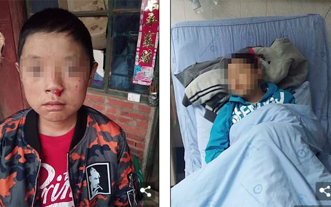 Cậu bé mắc bệnh 'ma cà rồng' quái ác, không thể ra nắng, mắt mũi đều xuất huyết Ảnh 2