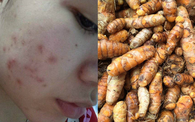 Có ngay 3 cách trị mụn bằng nghệ hiệu quả hơn cả mỹ phẩm tiền triệu Ảnh 2