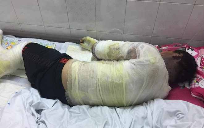 Lửa lan vào can xăng, hai vợ chồng bị bỏng nặng Ảnh 2