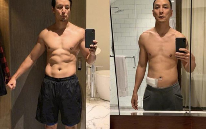 Ngô Ngạn Tổ tiết lộ bị viêm ruột thừa, chủ quan 3 ngày không khám bệnh, mưng mủ đến suýt mất mạng Ảnh 2