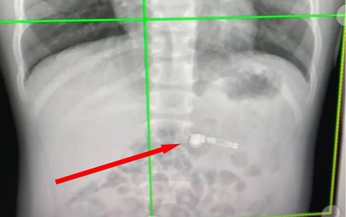 Cậu bé 7 tuổi nhập viện khẩn cấp vì nuối AirPods vào bụng Ảnh 2