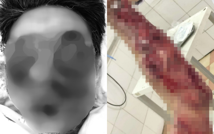 Kinh hãi người đàn ông bị dập nát khuôn mặt, cánh tay sau khi chơi pháo tự chế ngày cận Tết Ảnh 2