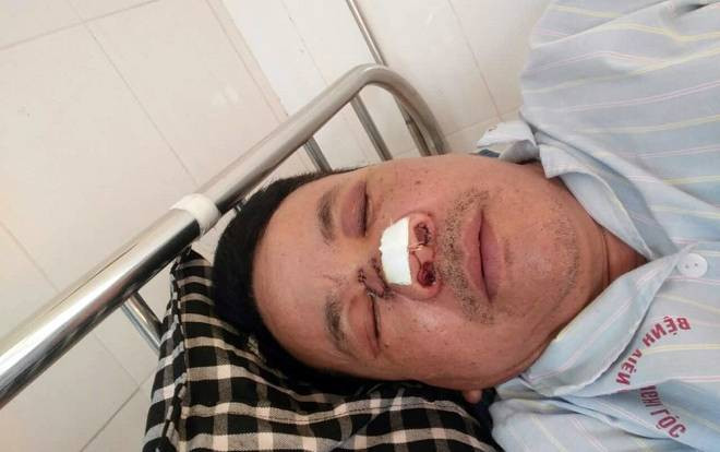 Bị đuổi theo, 2 thanh niên trộm chó dùng chai thủy tinh ném gãy mũi trưởng công an xã Ảnh 2