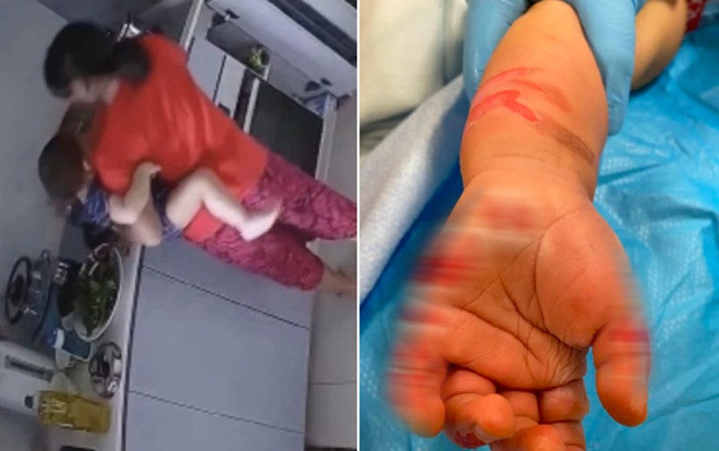 Người giúp việc nhúng tay bé gái 16 tháng tuổi vào nước sôi với lý do khó tha thứ Ảnh 2