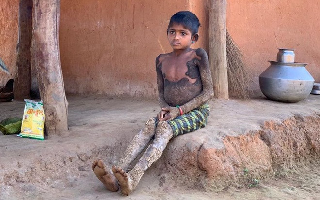 Mụn mọc quanh người vì bệnh hiếm khiến bé gái 'đang dần hóa đá' Ảnh 2