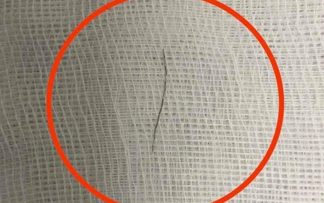 Phẫu thuật lấy đoạn thép dài gần 2cm trong họng bé 13 tháng tuổi Ảnh 2