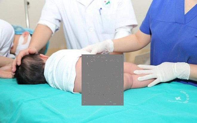 Hiếm gặp: Phẫu thuật cắt đuôi dài hơn 9 cm mọc từ lúc sinh ra cho bé gái 5 tháng tuổi Ảnh 2