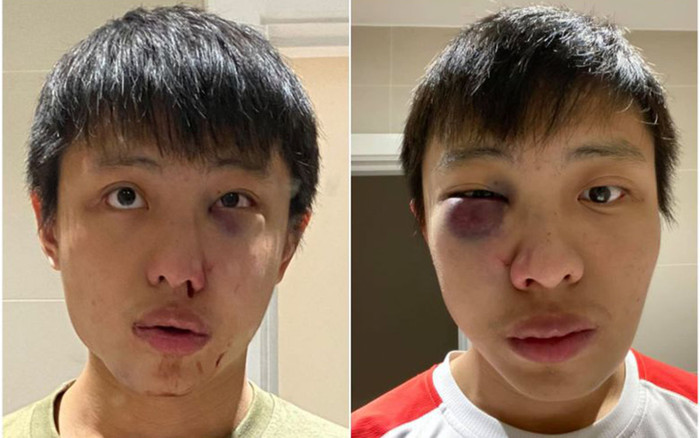 Du học sinh châu Á bị nhóm côn đồ đánh gãy xương mặt vì COVID-19 Ảnh 2