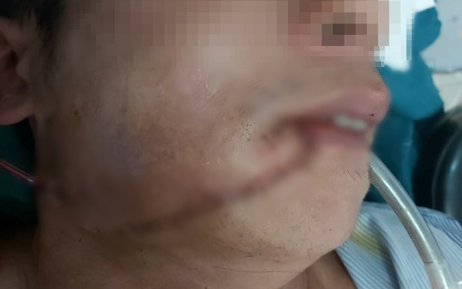 Bị trâu rừng húc, người đàn ông ở Hà Tĩnh phải khâu hơn 200 mũi Ảnh 2