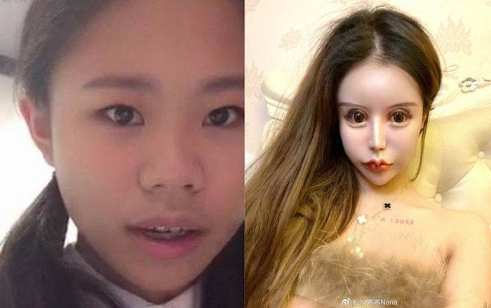 Phẫu thuật thẩm mỹ hơn 60 lần trong 3 năm, thiếu nữ biến dạng gương mặt nhưng không hối hận Ảnh 2