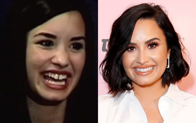 10 ngôi sao 'vịt hóa thiên nga' nhờ chỉnh nha, thu hẹp khoảng cách răng cửa Ảnh 2