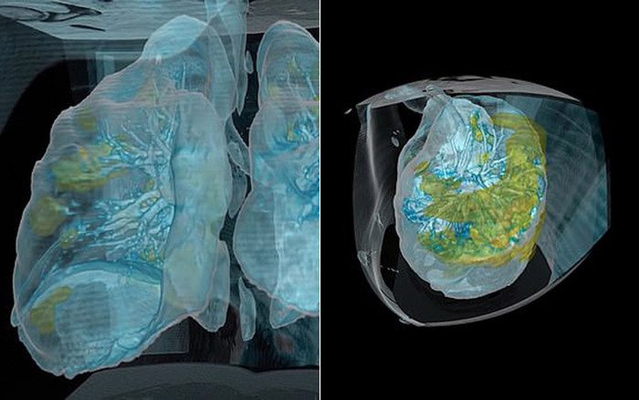 Video: Phổi của bệnh nhân COVID-19 tổn thương trên diện rộng chỉ sau vài ngày phát bệnh Ảnh 2