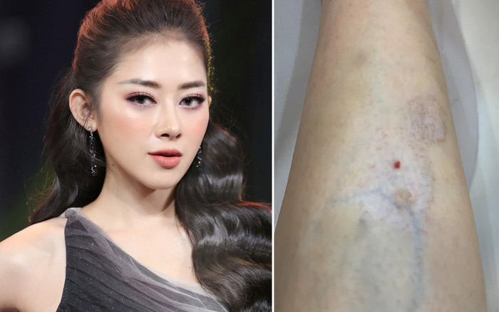 Hotgirl Mai Sương bị teo cơ do xóa thâm chân, suy sụp khi biết điều trị 10 năm liền cũng chỉ phục hồi 50% Ảnh 2