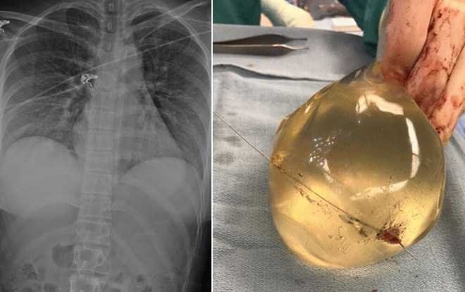 Bị đạn bắn trúng, người phụ nữ may mắn sống sót nhờ túi ngực silicon Ảnh 2