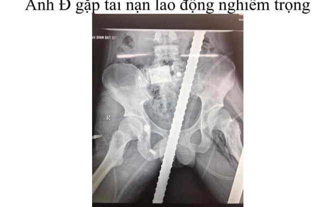 Cứu sống nam thanh niên bị hai thanh sắt xuyên qua người trong tình trạng sốc đa chấn thương Ảnh 2
