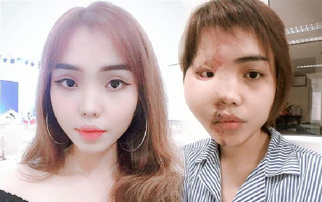 Cô gái bị chồng sắp cưới tạt axit biến dạng khuôn mặt: Sau 1 năm đã trở lại với nụ cười xinh đẹp rạng rỡ Ảnh 2