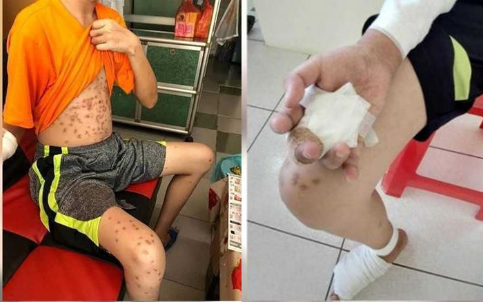 Đi làm để kiếm thêm thu nhập, chàng trai bị chủ nhốt và tra tấn tới mức phải cắt cụt 3 ngón chân Ảnh 2